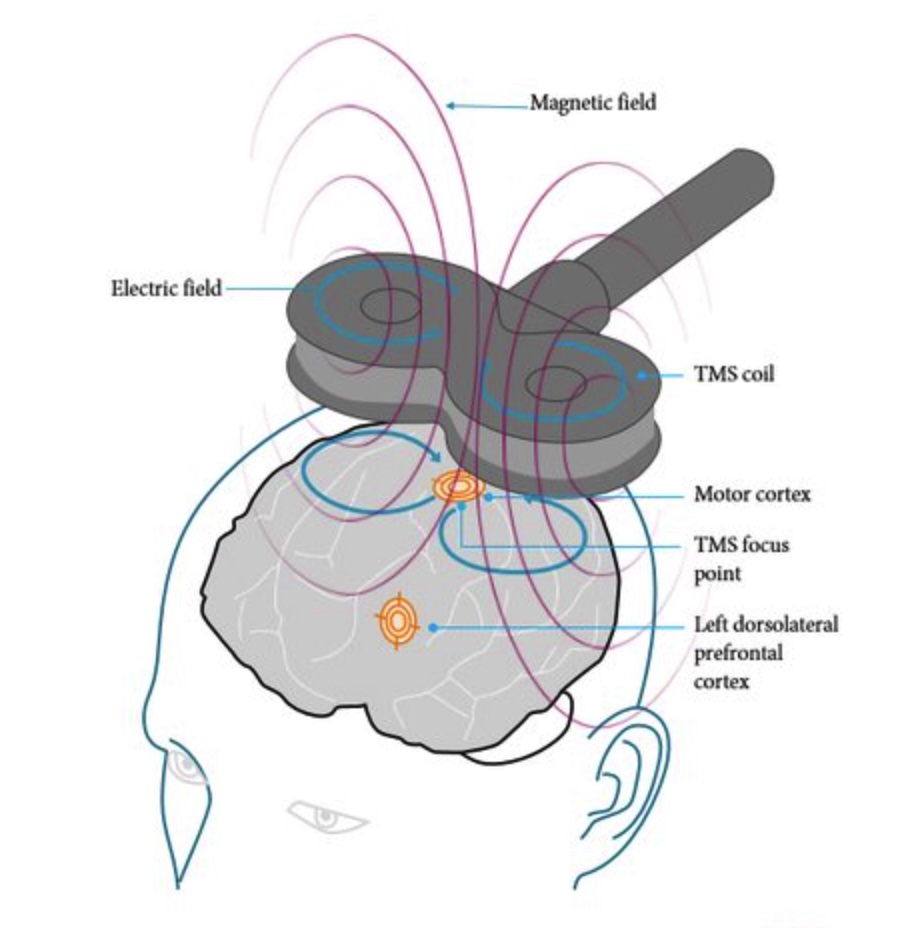 Illustration of how rTMS delivers magnetic stimulation to targeted brain regions
